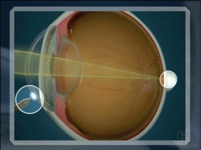 Keratoplasty